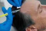 How to Achieve a Natural Look with FUE Hair Transplant