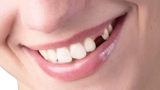 A Patient’s Journey: What to Expect During Missing Teeth Treatment