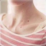 Where Can You Find the Best Mole Removal Treatment in Mumbai
