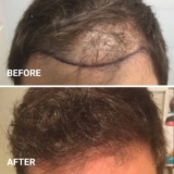 Rediscover Confidence with Hair Transplant Surgery on Long Island: What You Need to Know