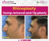 Understanding the Process of Nose Reconstruction Surgery