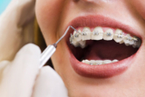 The Benefits of Orthodontic Treatment