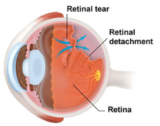 Your Trusted Retina Specialist in Ghatkopar: Clear Sight Eyecare