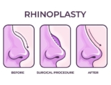 Rhinoplasty Surgery in Navi Mumbai: Redefining Facial Harmony