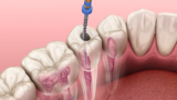 Root Canal Treatment: The Impact on Your Oral Microbiome