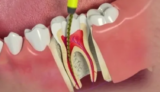 The Cost of Root Canal Treatment: Factors to Consider