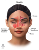 Understanding Sinusitis: Causes, Symptoms, and Treatment