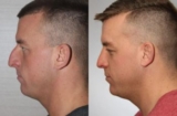 Revision Rhinoplasty: Why Finding the Right Surgeon Is Critical