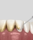 How teeth cleaning Can Improve Your Dental Hygiene