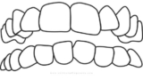 The Ultimate Guide to Braces for Crowded Teeth