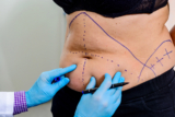 Is Tummy Tuck Surgery in Navi Mumbai the Right Choice for You?
