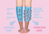 Laser Treatment for Varicose Veins in Tirunelveli