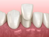 Dental Veneers for Overbite and Underbite Issues