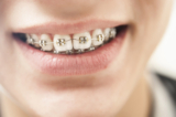 The Best Exercises for People with Braces