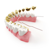 Top 5 Reasons to Consider Lingual Braces for Your Orthodontic Treatment