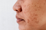 The Real Beauty of Freckles and Blemishes