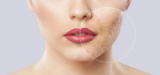Laser Scar Removal A Non-Invasive Solution for Smoother Skin