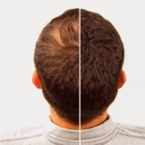 زراعة الشعر الهجينة باستخدام تقنيتي FUE وFUT